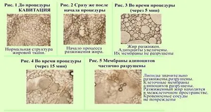 Кавитация ефект, процедурата, плюсовете и минусите