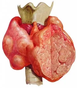 Coloid tratament gușă glandei tiroide remedii populare