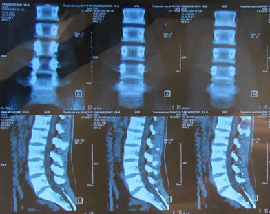 Tomografia computerizată a coloanei vertebrale, valoarea CT a coloanei vertebrale