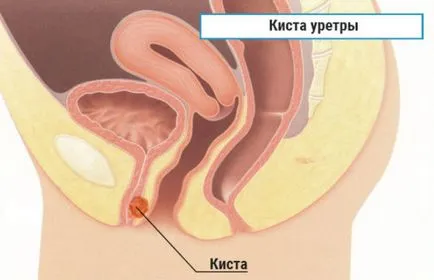 Уретра киста или киста лакунарен