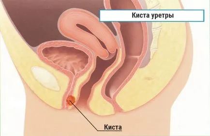 Ciszta húgycső nők - egy fotó és leírás klinikai esetek