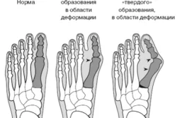 Bone privind cauzele picior și tratament