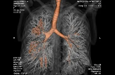 CT и MRI за рак на белия дроб прилича на тумор от картинката