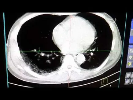 CT и MRI за рак на белия дроб прилича на тумор от картинката