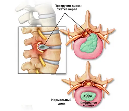 Лечение на лумбален диск издатина на билки