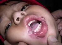 Cheilitis (fotokémiai, mirigyes, hámló, allergiás, atópiás ekcémában,