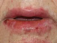 Cheilitis (fotokémiai, mirigyes, hámló, allergiás, atópiás ekcémában,