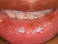 Cheilitis (fotokémiai, mirigyes, hámló, allergiás, atópiás ekcémában,