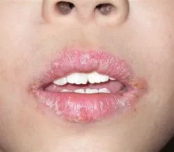 Cheilitis (fotokémiai, mirigyes, hámló, allergiás, atópiás ekcémában,