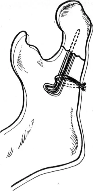 Sebészi kezelése mandibula törések - törések pofák