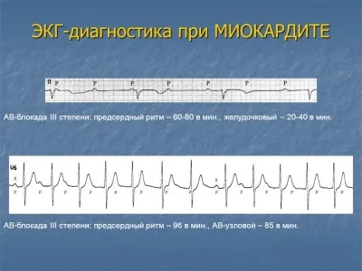 Krónikus szívizomgyulladás okoz, tünetek és a kezelés