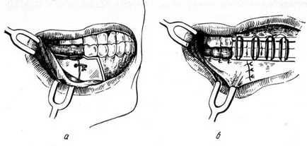 Sebészi kezelése mandibula törések - törések pofák