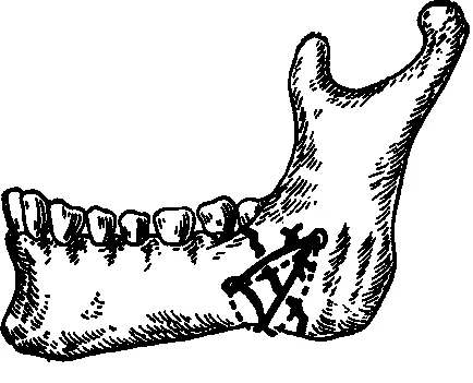 Sebészi kezelése mandibula törések - törések pofák