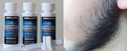 Minoxidil szakáll hatékony és megfizethető eszköz, amely felhasználható
