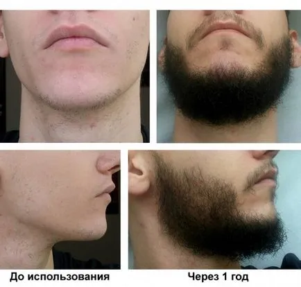 Minoxidil szakáll -, hogyan kell alkalmazni, és használja a növekedés felgyorsítása, eredmények rollback vélemények