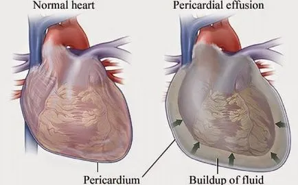Shell сърце - това е перикарден сърцето
