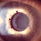 glaucom cu unghi ascuțit - periculoase tratament în Clinica de ochi Moscova