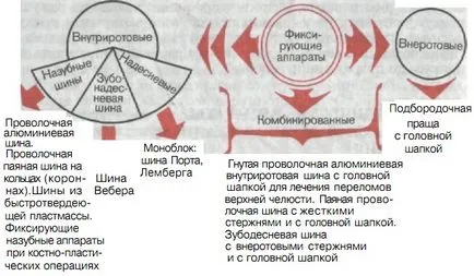 Ортопедични лечение на фрактури на челюстта заключващи устройства