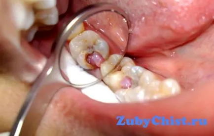 Основните симптоми на зъболекарите пулпит зъби мнение
