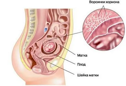 отлепване на плацентата в началото на бременността причинява плацента