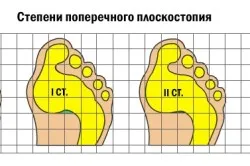 Крос плоско стъпало в детските симптоми и лечение