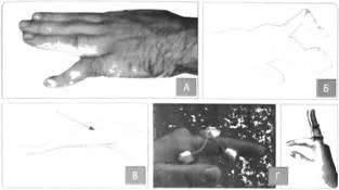 Deteriorarea ligamentelor, tendoanelor și mușchilor - Traumatologie și Ortopedie