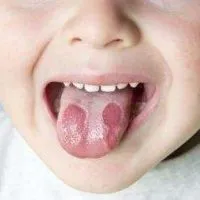 В каква заболявания има червени петна по езика на детето