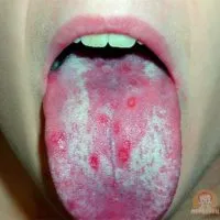 В каква заболявания има червени петна по езика на детето