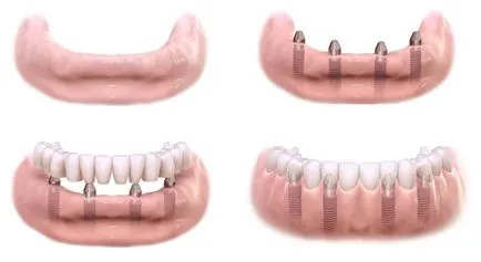 Видове зъбни протези (импланти, корони, протези сменяем меки), протеза е по-добре