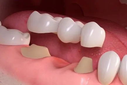 Видове зъбни протези (импланти, корони, протези сменяем меки), протеза е по-добре