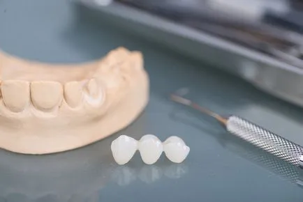 Típusai fogtechnika (implantátumok, koronák, fogpótlások kivehető puha), a protézis jobb
