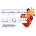 Szülés szívaritmia, tachycardia és arrhythmia