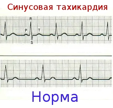 Naștere în aritmie cardiacă, tahicardie și aritmie