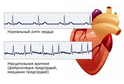 Szülés szívaritmia, tachycardia és arrhythmia