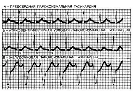 Szülés szívaritmia, tachycardia és arrhythmia