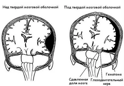 Compresiei creierului, cauzele și simptomele, de prim ajutor, diagnostic si tratament, populare