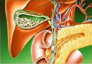 Камъни в жлъчката заболяване (GSD)