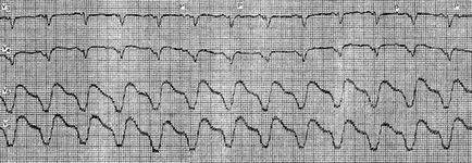 Kamrai tachycardia típus - piruett jellemzői és a kezelés