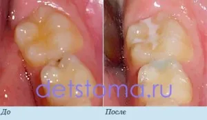 Metode moderne de tratare a cariilor dentare la copii