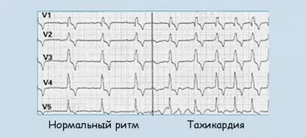 Тахикардия - това е, лечение на симптомите, причинява, профилактика и сърдечно-съдови заболявания