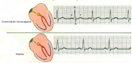 Tahicardia - ce este, tratarea simptomelor, cauzele, prevenirea, bolilor cardiovasculare