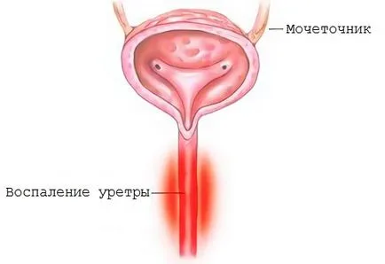 Gyertyák BPH, hogy melyiket válassza, és hogyan kell használni