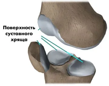 prejudiciu cartilajelor si chirurgie cartilajului, artroscopie genunchi