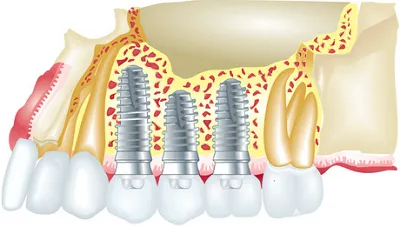 Tehnologia de instalare de implanturi dentare