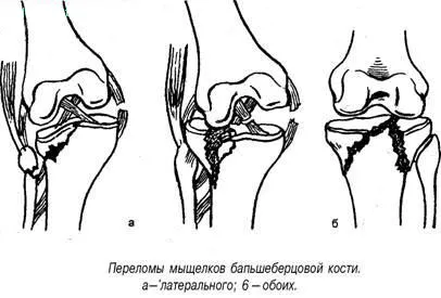 prejudiciu cartilajelor si chirurgie cartilajului, artroscopie genunchi
