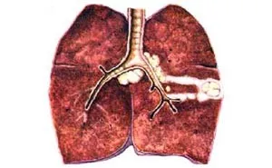 Tuberculoza bronhoadenit - simptome, tratament, diagnostic