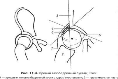 Ултразвукова диагностика на дисплазия