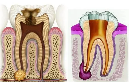 Care este riscul de granulom dentar