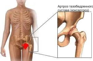 Разместване на бедрото при възрастни - симптоми и лечение