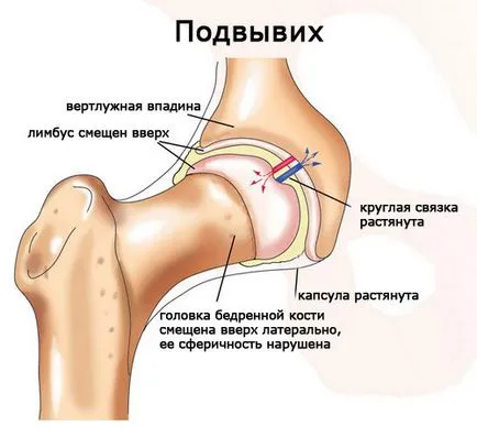 Разместване на бедрото